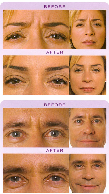 Before And After Botox Photos. BOTOX® Cosmetic is a simple,
